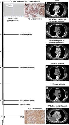 Case Report: Tumor Microenvironment Characteristics in a Patient With HER2 Mutant Lung Squamous Cell Carcinoma Harboring High PD-L1 Expression Who Presented Hyperprogressive Disease